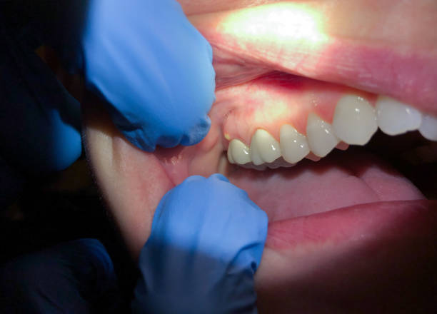 Best Emergency Dental Services for Seniors in Los Gatos, CA